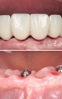ایمپلنت تخصصی و خدمات دندانپزشکی تبریز