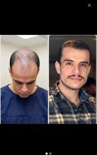 کاشت مو و ابرو در تهران