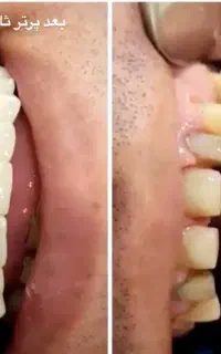 ساخت انواع دندان