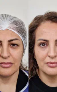 بلفاروپلاستی / عمل زیبایی پلک