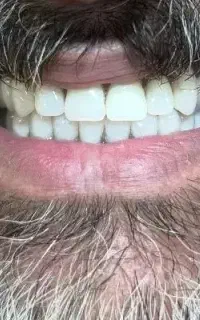 دندانسازی‌شروین/کروم‌کبالت/اوردنچر/دندان‌مصنوعی