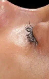عمل زیبایی بینی
