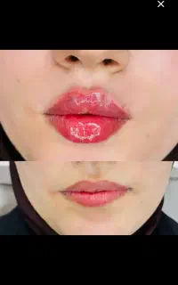 ژل بوتاکس فیلر مزو prp و prf اگزوزوم تراپی باتخفیف