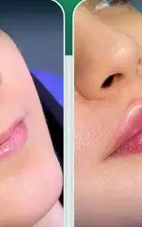 تزریق ژل با قیمت مناسب و اقتصادی