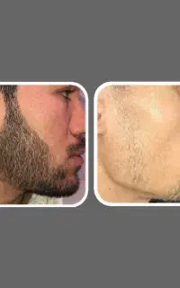 ریش یکدست