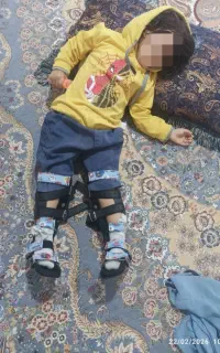 کفش طبی جهت برطرف کردن انحراف پای بچه