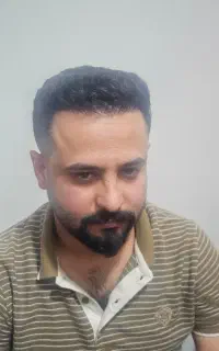 کاشت مو