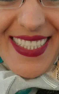 دندان مصنوعی دندانسازی بامجوز رسمی و ۵۰درصدتخفیف
