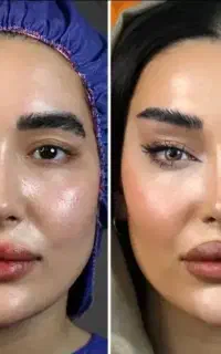 اندولیفت جراحی بلفا لیفت شقیقه گونه دایرکت ابرو لب