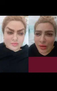دایرکت .تزریق وتخلیه چربی .بلفارو