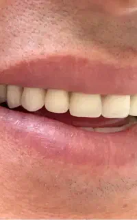 دندان مصنوعی اقساط یک روزه