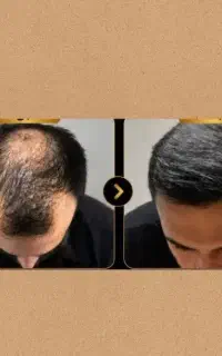 چرا هنوز ریزش مو داری ها