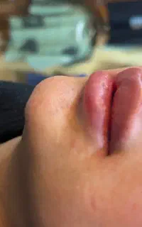 تزریق ژل با ماندگاری بالا