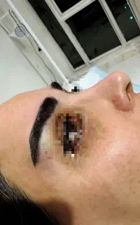 کاشت مو و ابرو