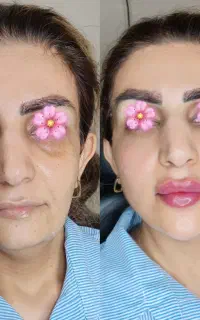 ژل و بوتاکس جشنواره تخفیف ویژه