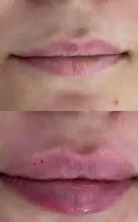 ژل و بوتاکس