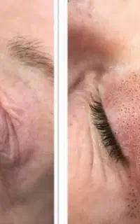 رفع چروک پیشانی چشم خط خنده جای جوش خالبرداری لیزر