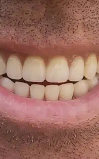 ساخت و تعمیر دندان متحرک با ضمانت