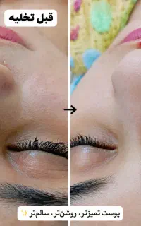 فیشیال تخصصی پوست باآفر ویژه آبرسانی کربوکسی‌تراپی