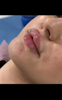 ژل لب وصورت