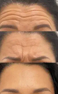 بوتاکس تخصصی صورت و زیربغل توسط پزشک