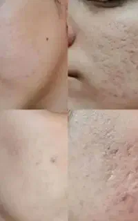 درمان قطعی جای جوش و اسکار تضمینی