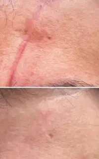 لیزر جای جوش و لک و بخیه