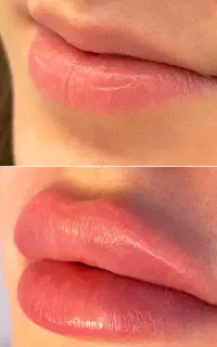 جشنواره آفر مدل ژل بوتاکس مزو مو جوانساز فیلر صورت