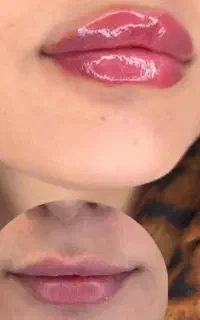 ژل و بوتاکس