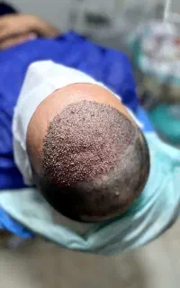 کاشت مو   کاشت ابرو             پی آر پی تخصصی
