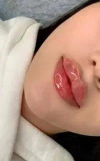 تزریق ژل و بوتاکس،تزریق چربی،لیفت نخ و prp