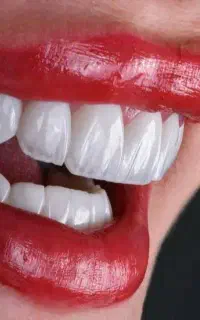 خدمات ایمپلنت بصورت اقساط با ضمانت ۱۰ ساله