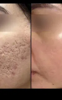 رفع جوش وجای جوش