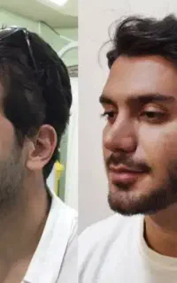 ژل بوتاکس فیلربادی