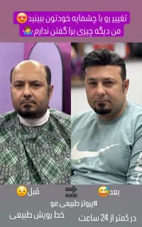 پروتز مو