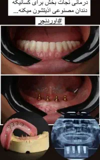 اوردنچر دندان مصنوعی متکی بر پایه ایمپلنت