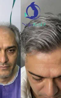 نژا کاشت مجموعه تخصصی کاشت مو و ابرو از سال 1383