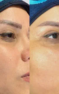 هزینه مواد برای فیشال و پاکسازی پوست