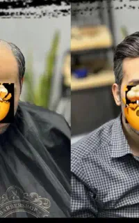 مرکز تخصصی پروتز مو ،جایگزین کاشت مو/همدان