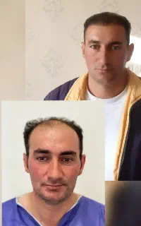 کاشت‌مو و ابرو فول تراکم