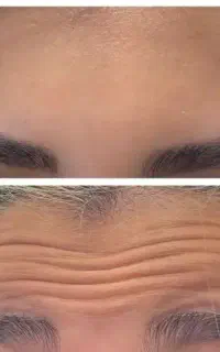 جوانسازی صورت و زیبایی