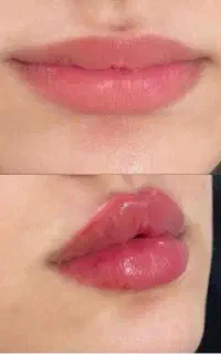 اف ۵۰٪ مطب پوست مو لیزر الکساندرایت