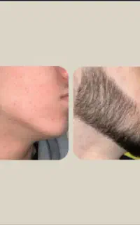 محلول رشد ریش و سیبیل و مو