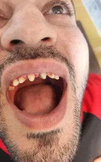 روکش دندان سرامیکی 2/600/000 ترمیم700 هزار تومان