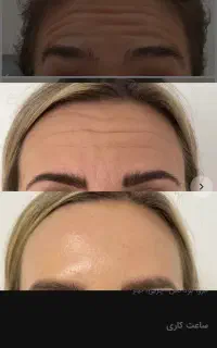 مدل برای بوتاکس و مزو مطب