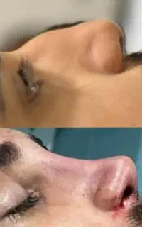 آف عمل زیبایی بینی۲۵ت اهوازتخلیه ابدولیفت‌ماموابدو