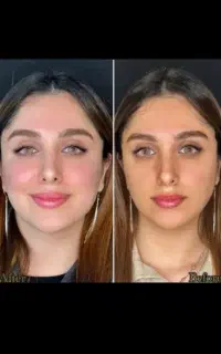 خدمات تخصصی ژل و بوتاکس