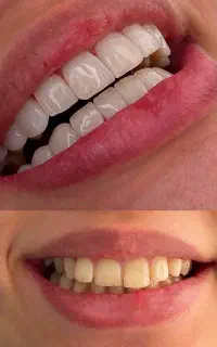 کامپوزیت دندان