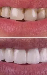 لمینیت دندان هر یک دندان ۷ تا ۹/۸ میلیون تومان