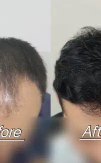 فرصت استثنایی تخفیف کاشت مو فول‌تراکم در شیراز